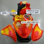 世界一わかりやすい心房細動と肺静脈隔離術のハナシ～治療　後編～